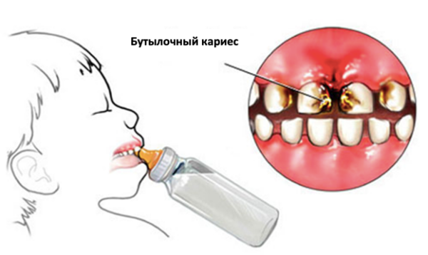 Сода для зубов